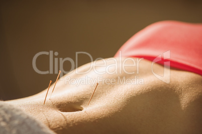 Young woman getting acupuncture treatment