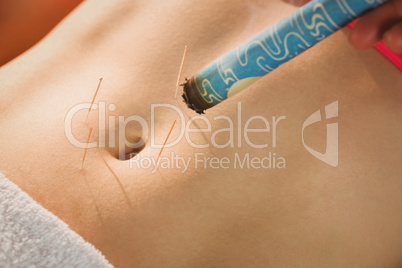 Young woman getting acupuncture treatment