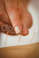 Young woman getting acupuncture treatment