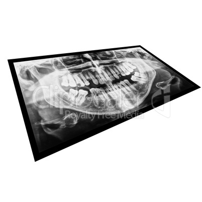 Black and white Medical Xray of teeth