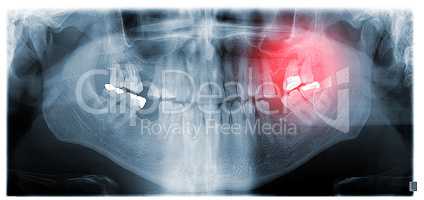Dental panoramic x-ray showing granuloma