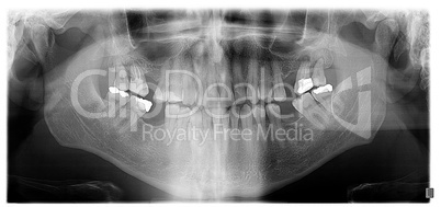 Dental panoramic x-ray, showing granuloma at upper second and th