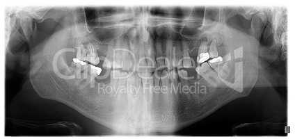 Dental panoramic x-ray, showing granuloma at upper second and th