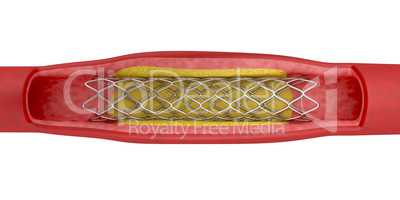 Angioplasty with stent placement