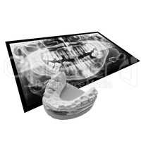 Black and white Xray of teeth with positive teeth cast