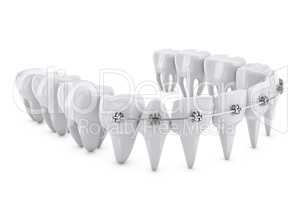 dental brackets