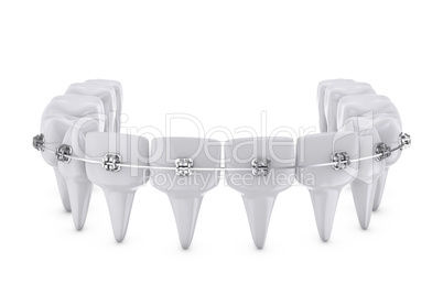 dental brackets