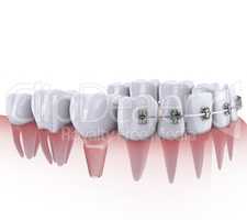 teeth and implant