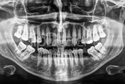 Human teeth xray in black and white