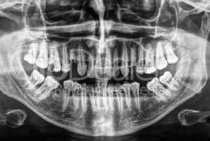 Human teeth xray in black and white