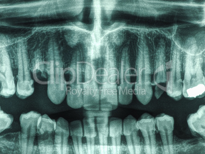 Human teeth xray