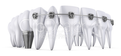teeth and implant