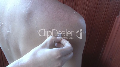 Sunburned peeling on back body a man