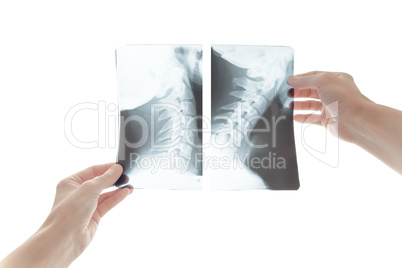 Young female doctor looking at the x-ray picture of cervical spine in a hospital