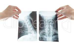 Radiologist looking at cervical spine image