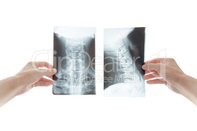 Radiologist looking at cervical spine image