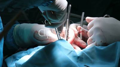 Surgeons putting on stitches after complex surgery