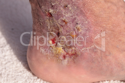 Medical picture: Infection cellulitis