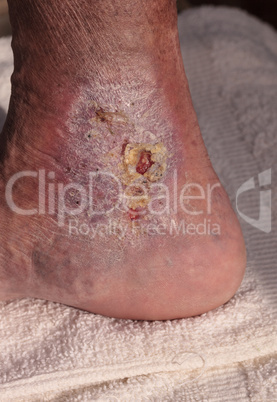 Medical picture: Infection cellulitis