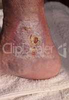 Medical picture: Infection cellulitis
