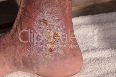 Medical picture: Infection cellulitis