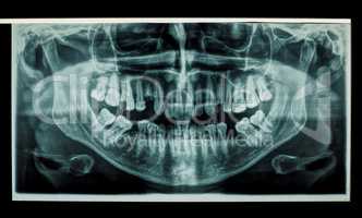 teeth panoramic xray