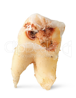 Closeup single tooth with caries vertically
