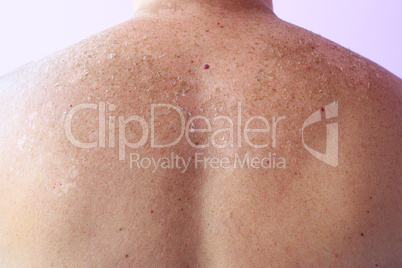 Traces of sunburn on the back of a man. Human skin after sunbathing