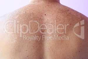 Traces of sunburn on the back of a man. Human skin after sunbathing