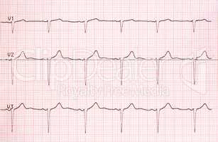 Electrocardiogram graph on paper