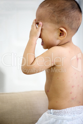 Baby boy with chicken pox crying