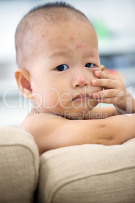 Baby boy with chicken pox at home