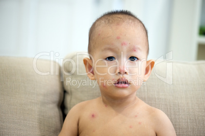 Baby boy with chicken pox on couch