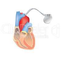 Heart pacemaker in work. Human heart anatomy with ICD