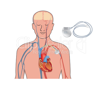 Heart pacemaker in work. Human heart artificial cardiac, ICD