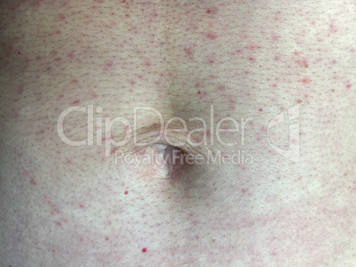 Close-up of skin red rash on woman belly