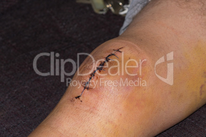 Male knee after meniscal surgery with medical suture