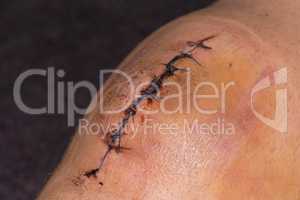Male knee after meniscal surgery with medical suture
