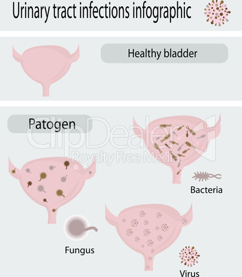 Urinary tract infection infographic