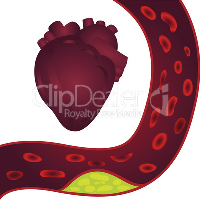 Cholesterol plaque in artery and a heart (atherosclerosis) illustration