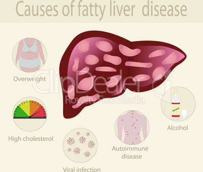 Causes of fatty liver disease infographics