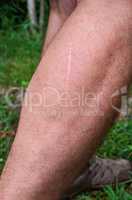 Long, thin scar on the leg