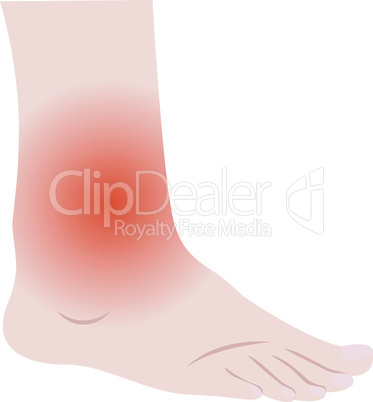 Swelling of the feet and ankles from infected or injury