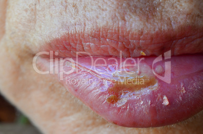 Macro shot of Herpes simplex labialis