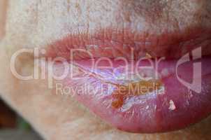 Macro shot of Herpes simplex labialis