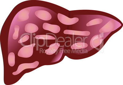 Liver affected by cirrhosis