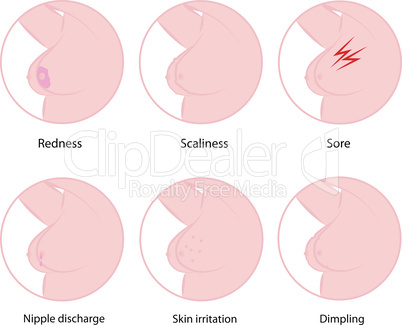 Early symptoms of breast cancer