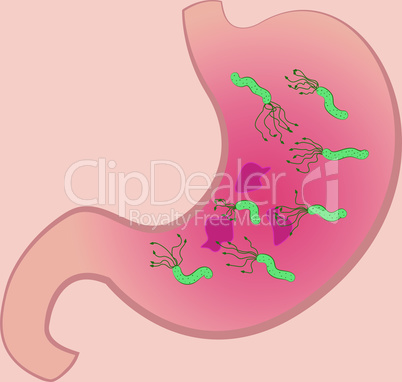 A Stomach with ucler and Helicobacter pylori
