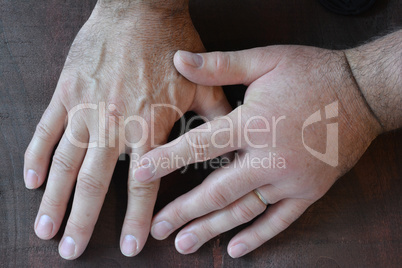 Swollen fist compared with healthy fist close up