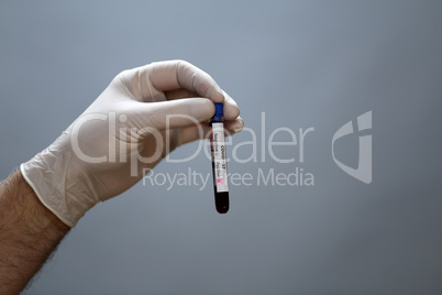 Coronavirus testing - A hand holds a test tube containing a patients sample that has tested positive for coronavirus